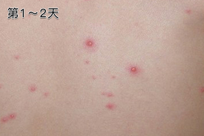 水痘第1-2天图片
