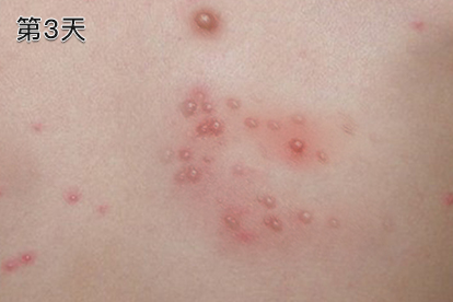 水痘第3天图片