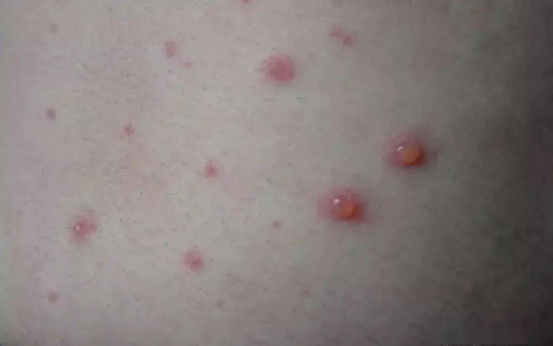 水痘的7天演变过程症状大全