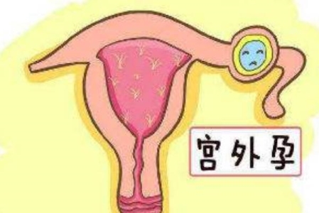 宫外孕的症状有哪些表现 宫外孕怎么办处理方法