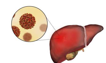 准妈妈如何及早发现肝炎 妊娠期肝炎能好吗