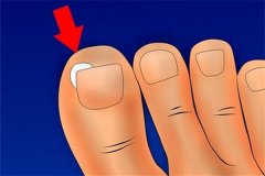 甲沟炎会自己好吗？甲沟炎擦碘伏能好吗？