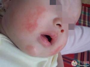宝宝湿疹涂药膏怎么涂 湿疹涂药膏正确方法