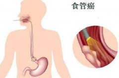 食道癌早期有哪些症状食道癌早期能治好吗？