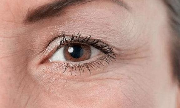 眼周有皱纹是缺水吗?去除皱纹的3个方法