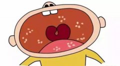 宝宝口腔出现奶块其实是病宝妈们该辩识鹅口疮