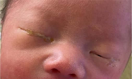 家长当心：这个病新生宝宝也会得