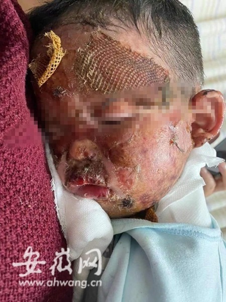 安徽一2岁宝宝被滚油泼到面部严重烫伤单亲妈妈离职守护后续治疗成难题